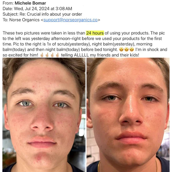Acne Killer Kit - Effective against Pimples, Redness and Pores