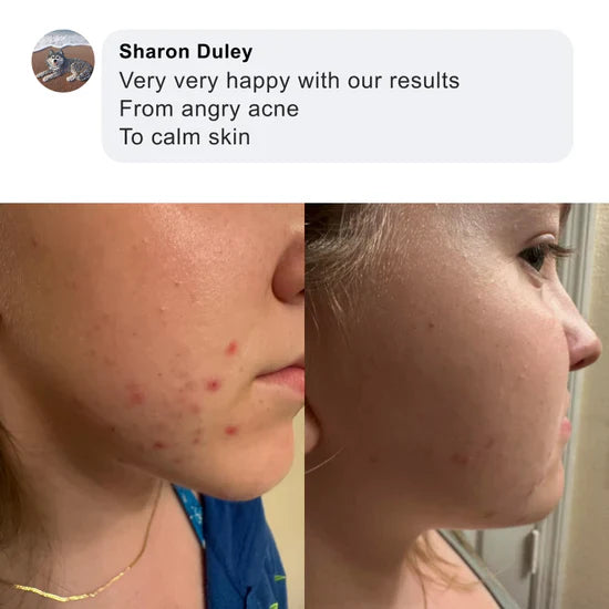 Acne Killer Kit - Effective against Pimples, Redness and Pores