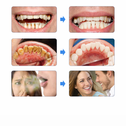 GlowSmile™ – Ultrasonic cleaning