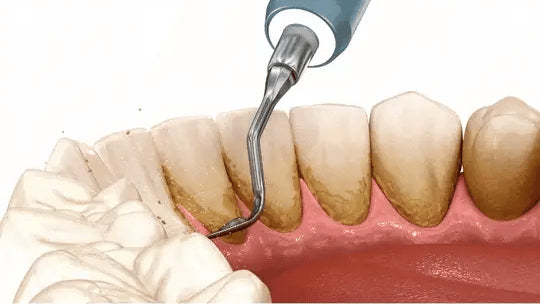 GlowSmile™ – Ultrasonic cleaning